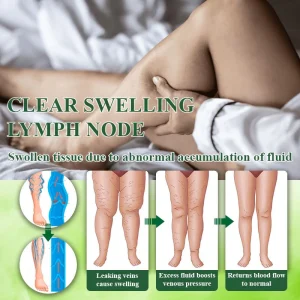 ATTDX® VeinoRoll Therapy Edema Comfort Cream 17 ATTDX® VeinoRoll Therapy Edema Comfort Cream