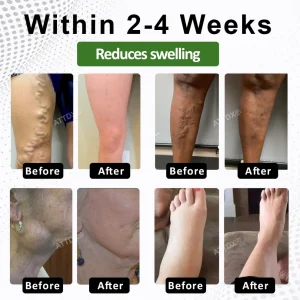 ATTDX® LymphoHerb Edema Support Capsules 12 ATTDX® LymphoHerb Edema Support Capsules