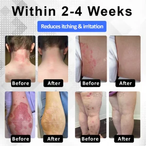 ATTDX® PsoriEase Magnesium Healing Foam 13 ATTDX® PsoriEase Magnesium Healing Foam