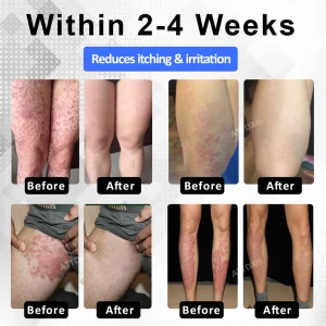 ATTDX® PsoriEase Magnesium Healing Foam 12 ATTDX® PsoriEase Magnesium Healing Foam