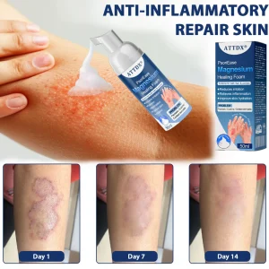 ATTDX® PsoriEase Magnesium Healing Foam 17 ATTDX® PsoriEase Magnesium Healing Foam