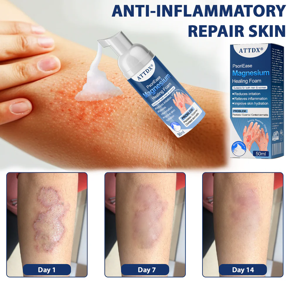ATTDX® PsoriEase Magnesium Healing Foam 7 ATTDX® PsoriEase Magnesium Healing Foam