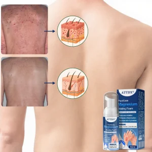 ATTDX® PsoriEase Magnesium Healing Foam 18 ATTDX® PsoriEase Magnesium Healing Foam