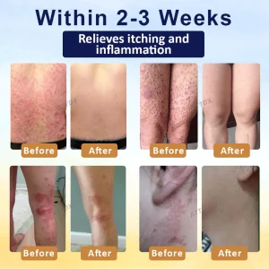 LOVILDS™ Psoriasis Care Mellifera Venom Skin Healing Spray 13 LOVILDS™ Psoriasis Care Mellifera Venom Skin Healing Spray