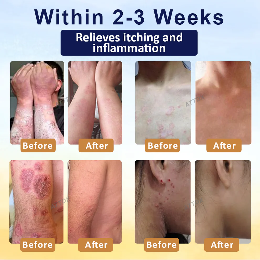 LOVILDS™ Psoriasis Care Mellifera Venom Skin Healing Spray 3 LOVILDS™ Psoriasis Care Mellifera Venom Skin Healing Spray