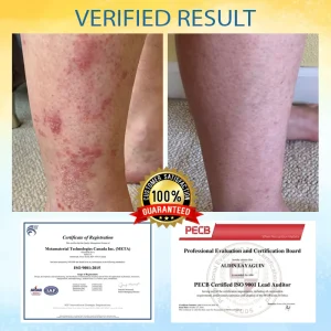 LOVILDS™ Psoriasis Care Mellifera Venom Skin Healing Spray 15 LOVILDS™ Psoriasis Care Mellifera Venom Skin Healing Spray