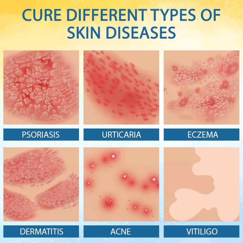 LOVILDS™ Psoriasis Care Mellifera Venom Skin Healing Spray 7 LOVILDS™ Psoriasis Care Mellifera Venom Skin Healing Spray