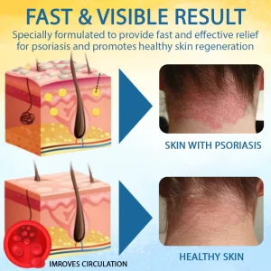 LOVILDS™ Psoriasis Care Mellifera Venom Skin Healing Spray 16 LOVILDS™ Psoriasis Care Mellifera Venom Skin Healing Spray