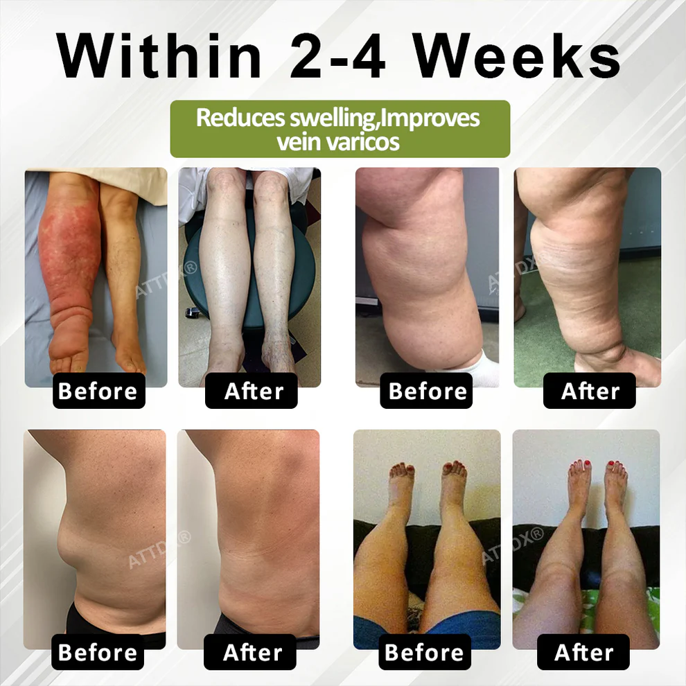 ATTDX® VeinoRoll Therapy Edema Comfort Cream 2 ATTDX® VeinoRoll Therapy Edema Comfort Cream
