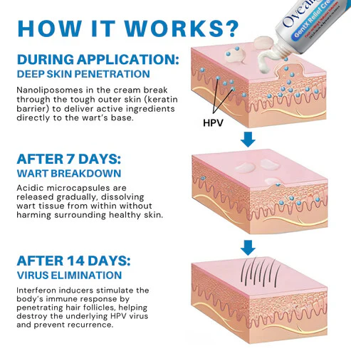 Oveallgo® HPV Genital Warts Relief Cream 4 Oveallgo® HPV Genital Warts Relief Cream