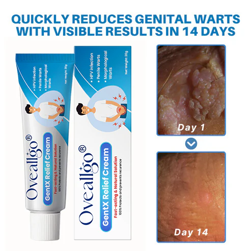 Oveallgo® HPV Genital Warts Relief Cream 2 Oveallgo® HPV Genital Warts Relief Cream