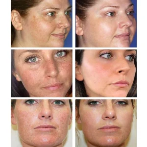 Bikenda™ Blemish Removing Beauty Cream