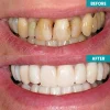 LIMETOW™ Instant Teeth Whitening Paint 11 LIMETOW™ Instant Teeth Whitening Paint