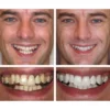 LIMETOW™ Teeth Whitening Essence 10 LIMETOW™ Teeth Whitening Essence