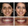 LIMETOW™ Teeth Whitening Essence 9 LIMETOW™ Teeth Whitening Essence